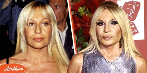 donatella versace face problems.